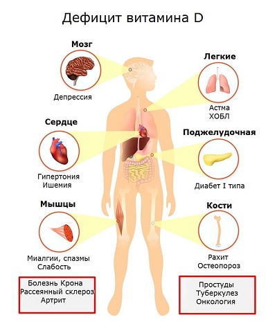 Последствия дефицита витамина Д